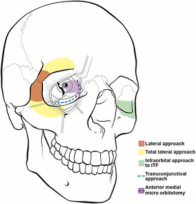 Cranio-Orbital and Orbitocranial Approaches to Orbital and Intracranial Disease: Eye-Opening Approaches for Neurosurgeons